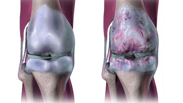 Здоровые коленные суставы и пораженные артрозом