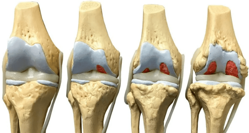 повреждение коленного сустава на разных стадиях развития артроза