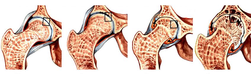 Стадия развития артроза тазобедренного сустава