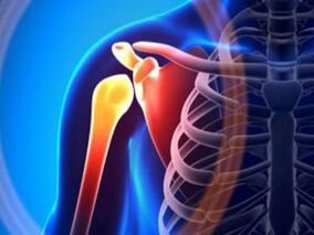 Воспаленные плечевые суставы вследствие артроза – хронического заболевания опорно-двигательного аппарата. 